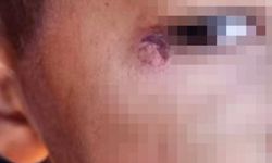 Şanlıurfa'da hademe öğrencinin gözünde sigara söndürdü! İfşa oldu