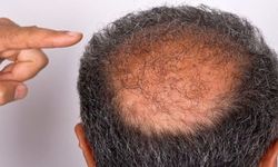 Kellik tedavisinde yeni yöntem! Ağ hücreleri uyarılarak saç köklerini aktifleştir