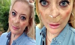 İngiliz kadın Türkiye'de kabusu yaşadı: Burnu çöktü