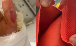 Sıcak su torbası kabusu oldu: Vücudu yandı