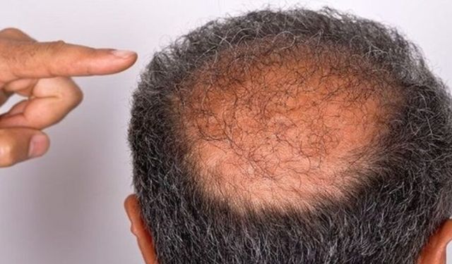 Kellik tedavisinde yeni yöntem! Ağ hücreleri uyarılarak saç köklerini aktifleştir
