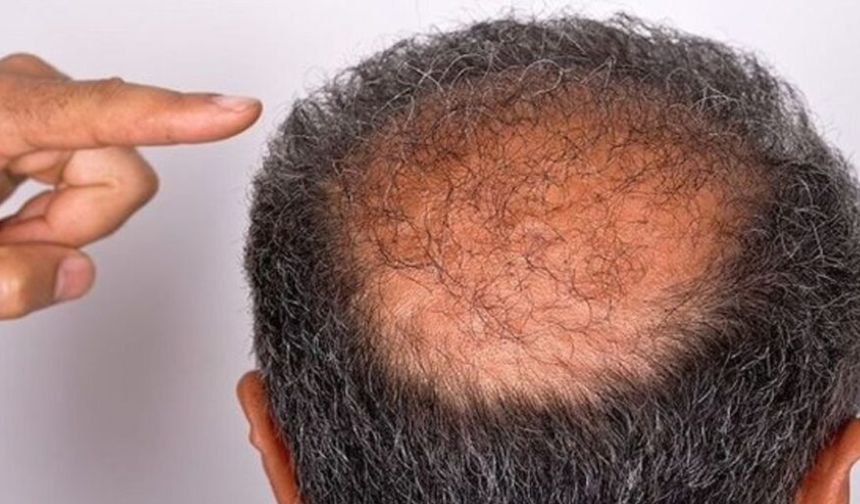 Kellik tedavisinde yeni yöntem! Ağ hücreleri uyarılarak saç köklerini aktifleştir